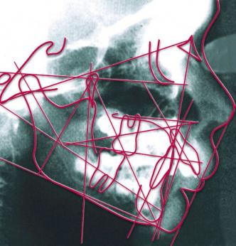 Fernröntgen-Seitenaufnahme