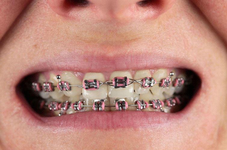 Metall-Brackets mit Drahtbogen