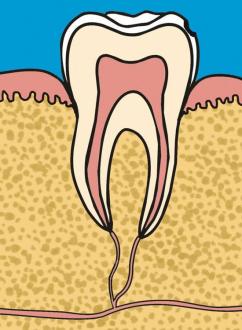 Kavität im Zahnschmelz